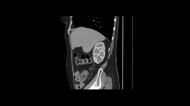 Contrast-Enhanced CT Abdomen and Pelvis Arterial Phase Sagittal 1.25 mm DICOM Medical Imaging Anatomy Loop