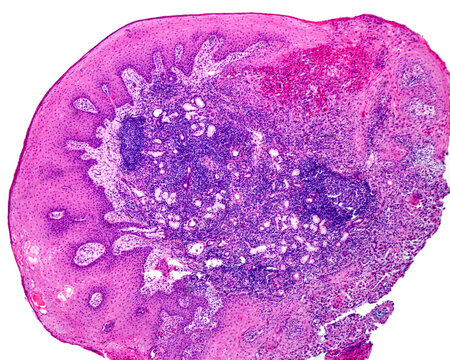 Human larynx. Squamous cell carcinoma