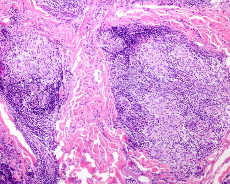 Human skin. Leprosy