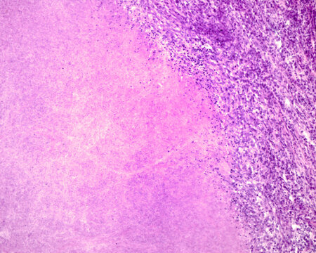 Human lymph node. Caseous tuberculous lymphadenitis