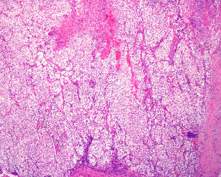 Renal cell carcinoma