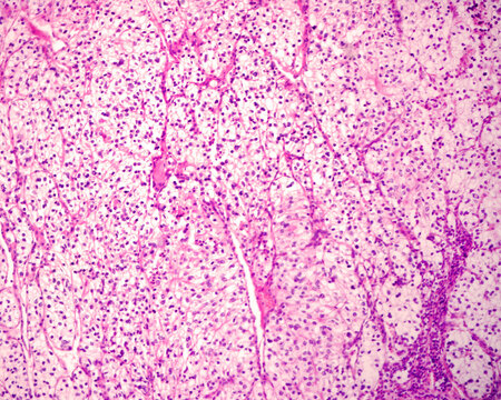 Renal cell carcinoma