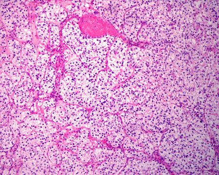 Renal cell carcinoma