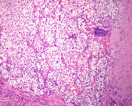 Renal cell carcinoma