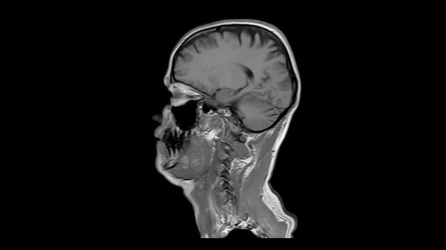 Magnetic resonance imaging MRI of human brain in sagittal view. Medical diagnostic animation sequence of head and spine structure on black background.