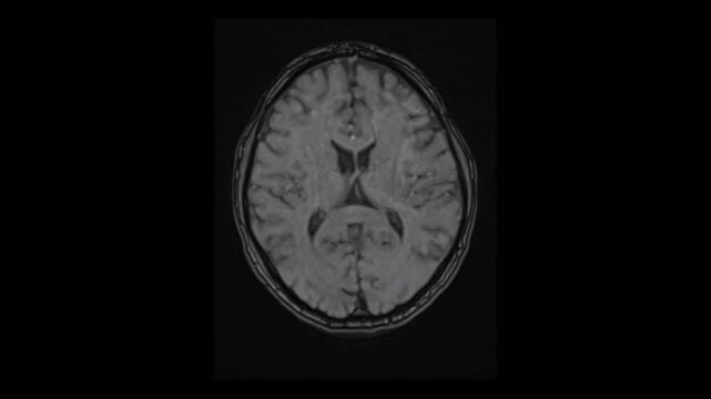 Brain MRI scanning showing skull base and eyes in axial view. Conceptual medical visual animation sequence for radiology and neural diagnostic.