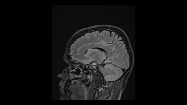 Detailed MRI scan of human head and neck in sagittal plane. Animated sequence of medical examination mapping brain tissue and spine structures close up.