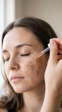 Caucasian Woman with Melasma Apply Serum Dropper on Hyperpigmentation Close-Up for Skincare Treatment