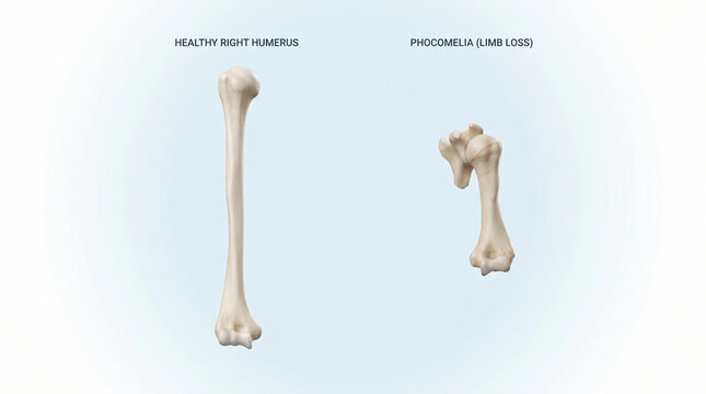 Phocomelia bone deformity and healthy humerus anatomy comparison 3D illustration
