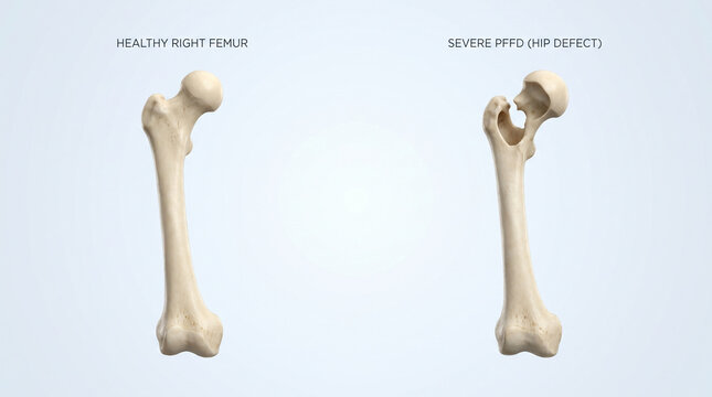 Severe PFFD hip defect and healthy femur bone anatomy comparison
