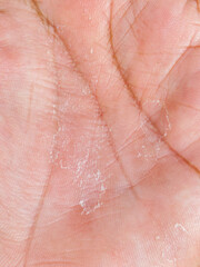 Fototapeta premium Closeup of dry human palm skin with peeling texture and visible lines, highlighting dehydration, skincare, dermatology, and natural skin detail.