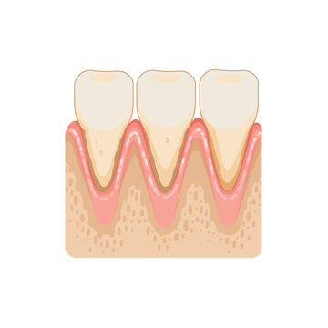 Gum Recession Anatomy Illustration
