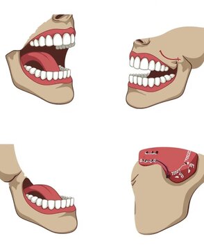 Tooth Cross-Section With Cavity Shown Alongside FDI Numbering Reference Diagram.