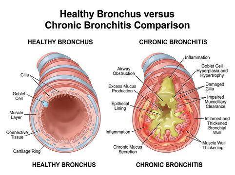 Healthy bronchus vs chronic bronchitis cross-section comparison illustration isolated on white background