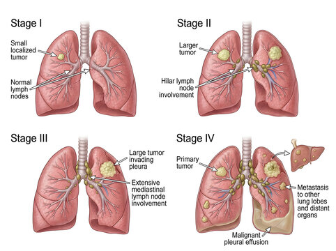 Lung cancer stages illustration with tumors and lymph nodes isolated on white background