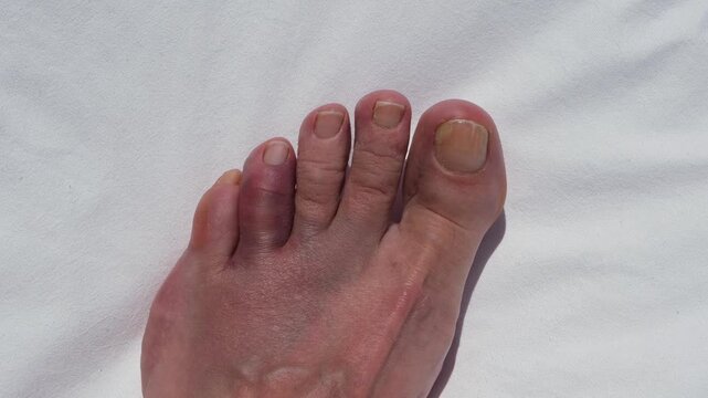Bruised and swollen toe after hitting a rock, concept of foot injury, pain, trauma, healthcare and recovery.