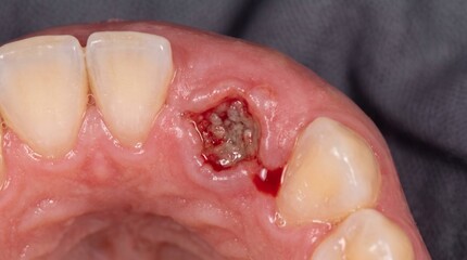 Fototapeta premium Oral cancer gum lesion close up macro photograph showing ulcerative lower gum tissue breakdown irregular borders adjacent teeth and wet mucosal texture