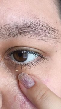 Woman touching milia near the eye, facial skin care, milia removal, dermatology and cosmetic skin treatment concept.