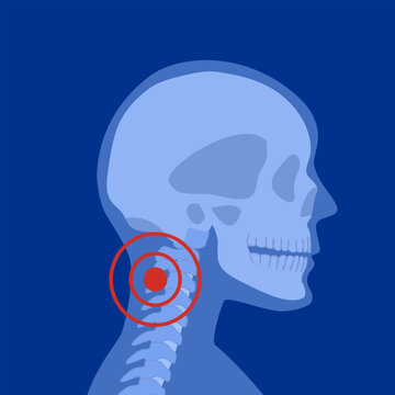 Pain in neck or spine bones. Skeleton x ray silhouette medical poster. Joints and cartilage in human body concept. Rheumatoid arthritis, inflammation, backbone disease concept flat vector illustration