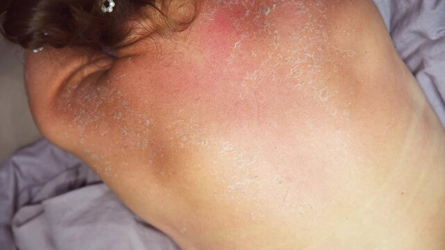 Peeling skin with desquamation after sunburn on upper back under soft indoor lighting
