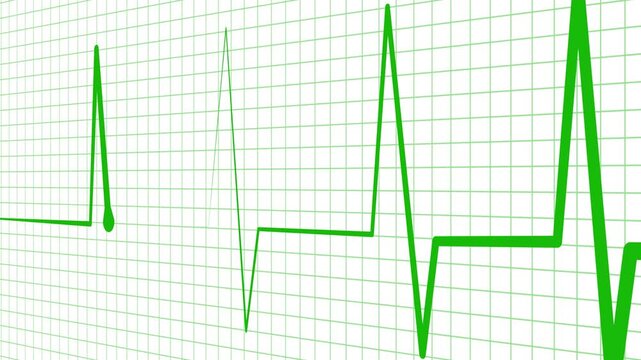 Ecg heart rhythm line on graph paper showing pulse spikes and flat line animation