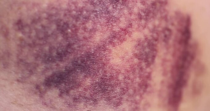 Purple bruise on the skin, a large bruise formed on the human body after a severe bruise or mechanical injury to soft tissues