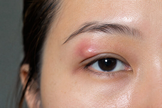 Close-Up of Swollen Upper Eyelid Consistent with Chalazion or Stye