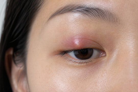 Close-Up of Inflamed Upper Eyelid Before Chalazion or Stye Treatment