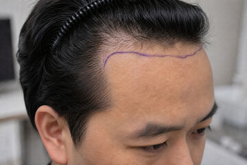 Fototapeta premium Three-Quarter View of Preoperative Hairline Design Before FUE Hair Transplant
