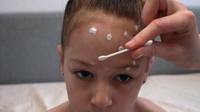 Mother applies chickenpox remedy on face of her daughter. Chickenpox treatment at home. 7 years old child with chickenpox. Mom lubricates rash from chickenpox with antiseptic using cotton bud.