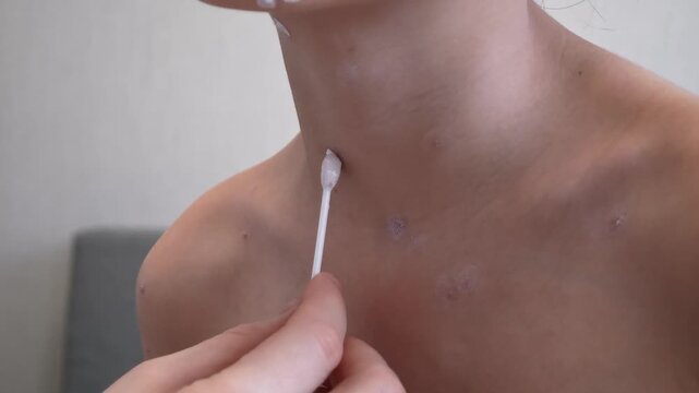 Mother applies chickenpox remedy on neck of her child. Chickenpox treatment at home. 7 years old child with chickenpox. Mom lubricates rash from chickenpox with antiseptic using cotton bud.