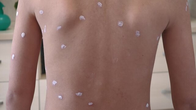 Back of child with chickenpox rash. Chickenpox treatment at home. 7 years old child with rash from chickenpox and with antiseptic on skin. Child suffers from chickenpox.