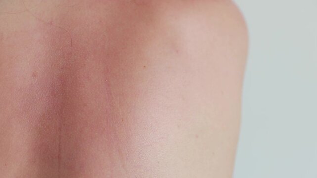 Close up of sunburnt skin on human upper back. Red painful sunburned skin on person back after sun exposure, uv damage. concept of UV sun damage and dermatology healthcare