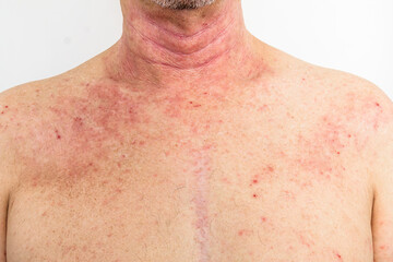 Naklejka premium Adult man's neck and chest showing red atopic dermatitis rash patches, dermatology medical photography, skin condition close-up, eczema awareness.