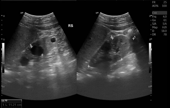 Ultrasound of the Gallbladder Demonstrating Multiple Cholelithiasis