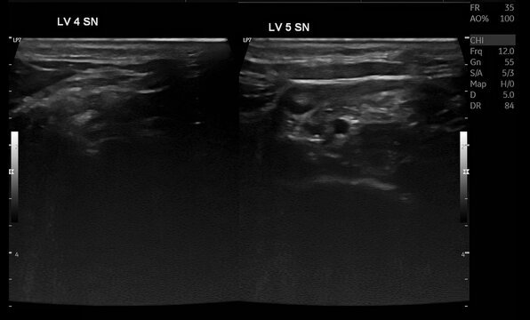 Thyroid Ultrasound Demonstrating Right Thyroid Nodule Classified as TI-RADS 3