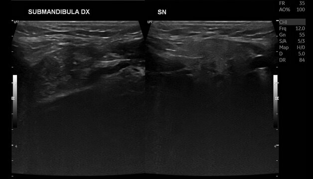 Thyroid Ultrasound Demonstrating Right Thyroid Nodule Classified as TI-RADS 3