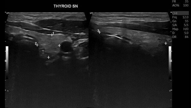 Thyroid Ultrasound Demonstrating Right Thyroid Nodule Classified as TI-RADS 3