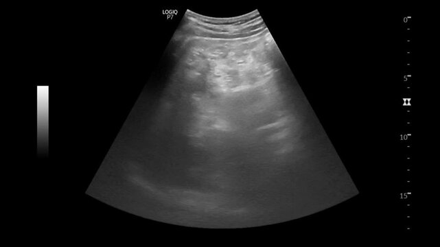 Abdominal ultrasound demonstrates multiple echogenic calculi within the gallbladder lumen, producing characteristic posterior acoustic shadowing consistent with multiple cholelithiasis. Ultrasonograph
