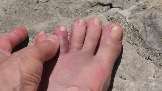 A swollen and bruised toe after accidentally hitting a rock on a beach vacation. Foot injury concept, accident, first aid, healthcare, and recovery.