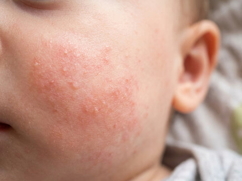 Close-up of baby's red, irritated cheek with eczema rash and bumps, indicating sensitive skin or an allergic reaction, concept of infant skin conditions and pediatric dermatology.