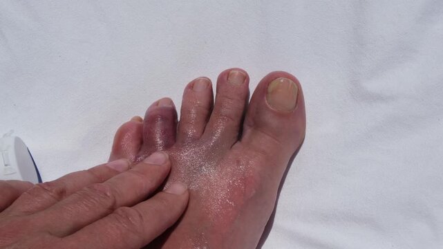 Applying pain relief ointment to an injured swollen toe after hitting a rock during a seaside vacation, concept of first aid, healthcare and recovery.