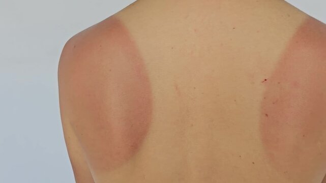Sunburn marks on skin shown from different angles after a day at the beach, highlighting the need for sun protection and skincare routines