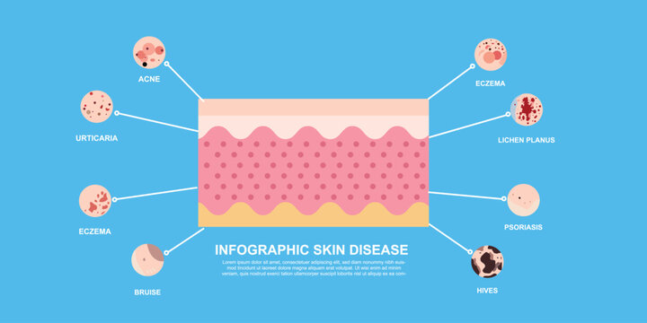 Medical illustration of various skin disorders and infections like warts, bruise, eczema, and chronic psoriasis vector.