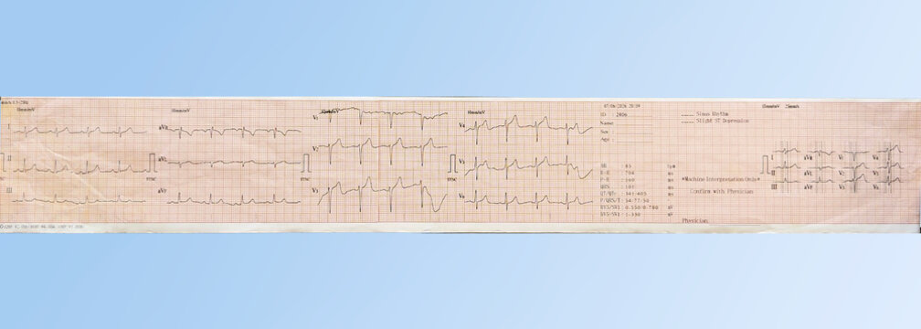12‑lead ECG printout on pink grid paper with waveforms, measurements, and patient data fields.