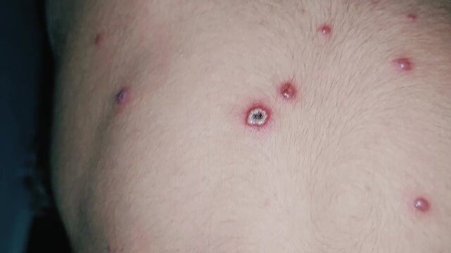 Close Up Examination Of Chickenpox Rash On Human Skin