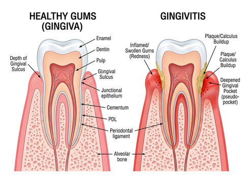 Healthy gums vs gingivitis dental anatomy comparison illustration isolated on white background