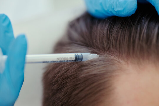 Close up of clinician performing scalp injection on adult patient, treating hair loss with cosmetic medicine. Ideal for dermatology, hair restoration, aesthetic clinic marketing