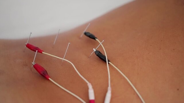 insertion of acupuncture needles into human skin close-up clinical therapeutic medical procedures healthcare tone red black white insertion needles skin close-up clinical therapeutic needl.