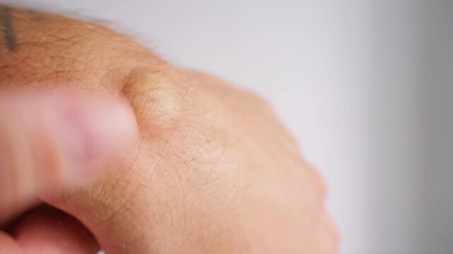 Close Up View of Human Finger Pressing Wrist Ganglion Cyst on Hand, Visible Soft Tissue Lump, Health Awareness, Orthopedic Condition, Medical Examination